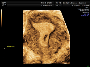 sinechia endometriale.jpg